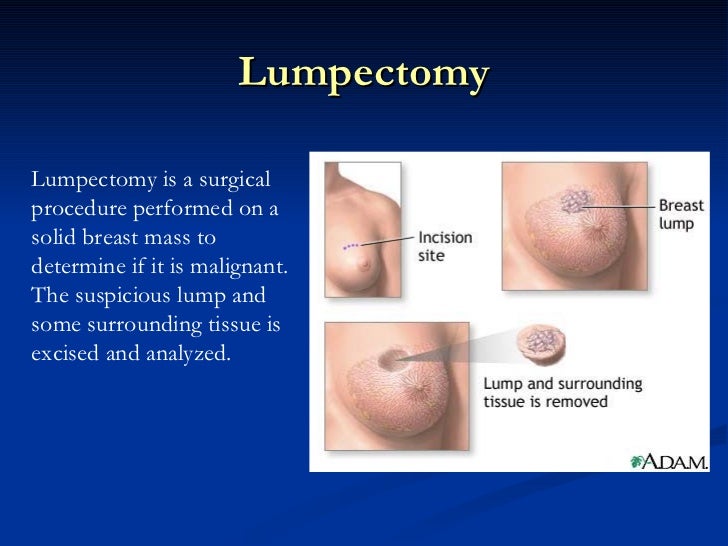breast nodule surgical biopsy Black cum oral shot
